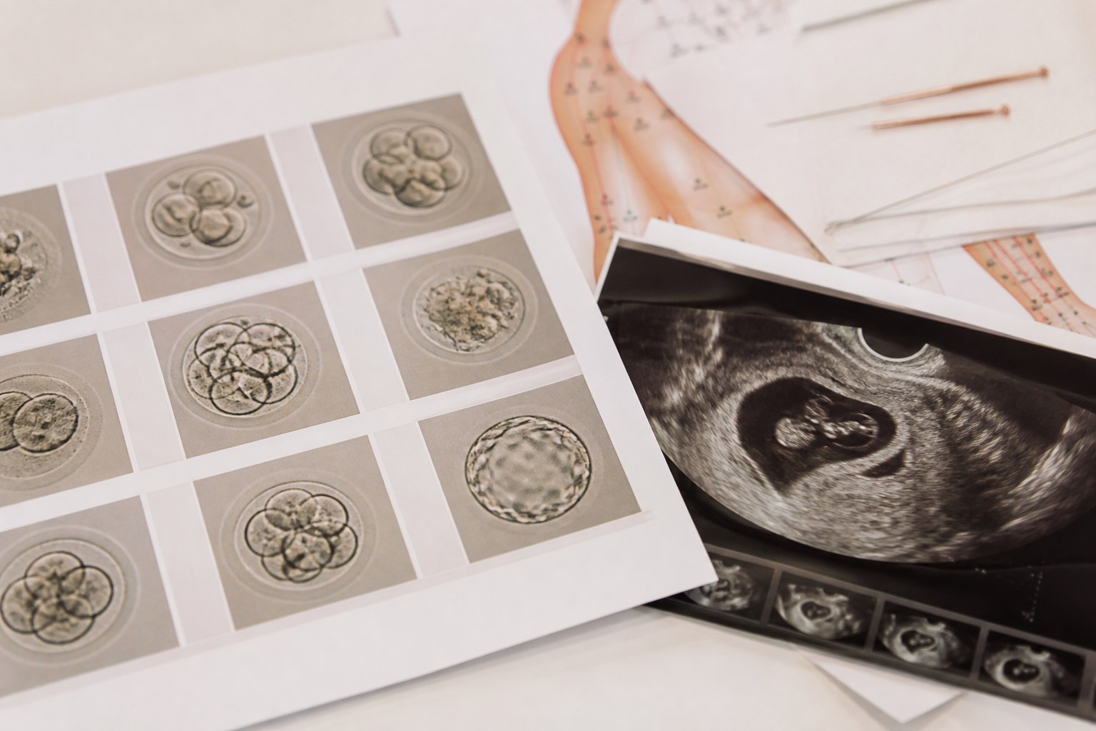 Medical charts and ultrasound showing embryo quality in fertility treatments with acupuncture
